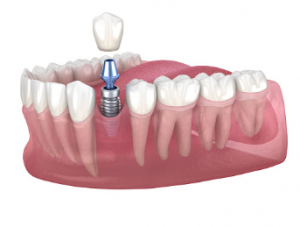 https://yesdentistry.com.au/affordable-dental-implants-adelaide
