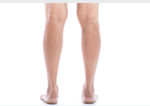 varicose vein removal Adelaide