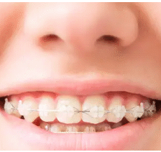Dental Braces Adelaide- Boosting Confidence with Real Stories from Adelaide Residents