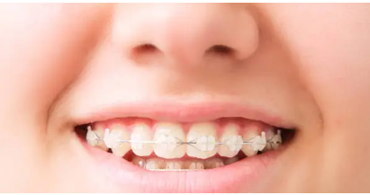 dental braces Adelaide